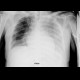 Pleural effusion, supine radiograph and after evacuation: X-ray - Plain radiograph